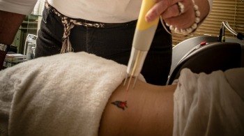 How Does Laser Tattoo Removal Actually Work?